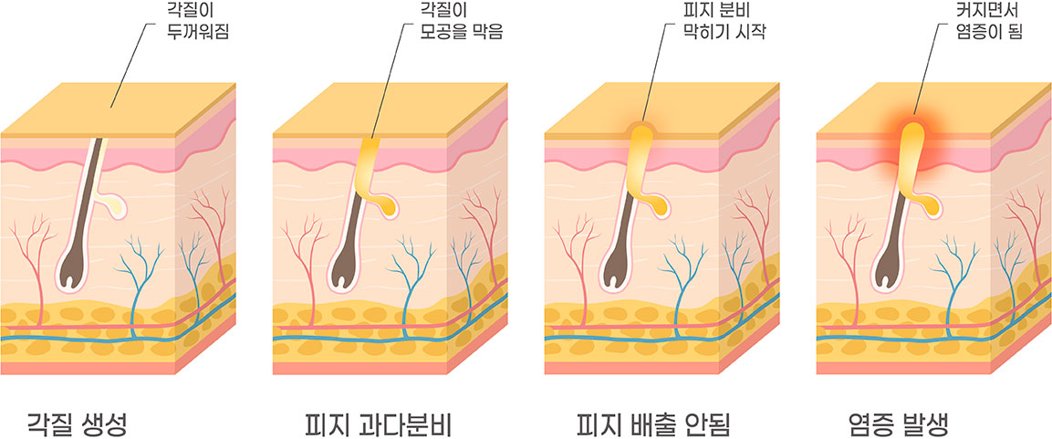 여드름 발생순서 1 각질이 두꺼워짐 2 각질이 모공을 막음 3 피지 분비 막히기 시작  4 커지면서 염증이 된다 
